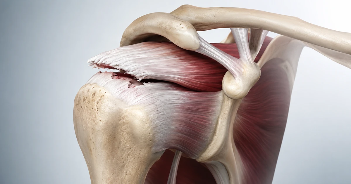 Anatomia do ombro mostrando a ruptura de um tendão do manguito rotador, com as bordas do tendão afastadas